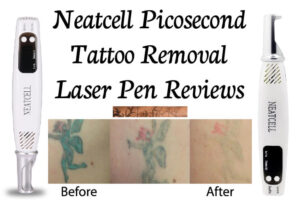 neatcell tattoo removal reviews