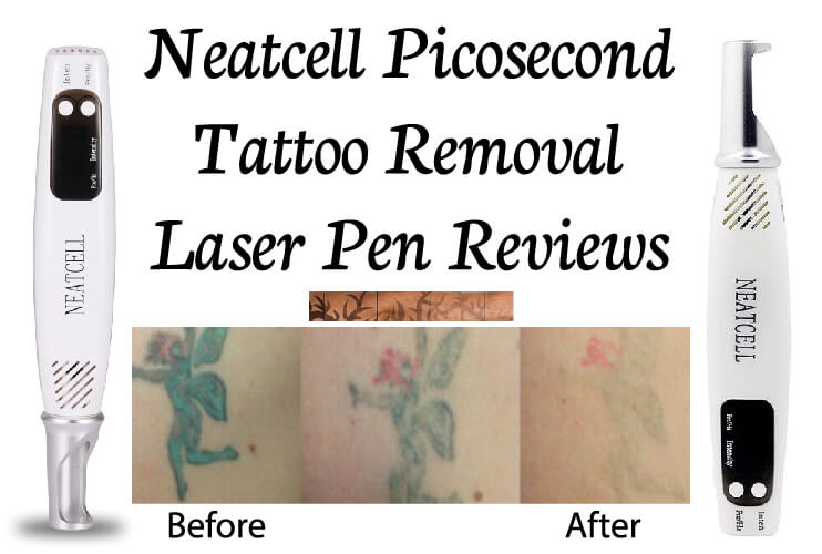 5 Best Laser Tattoo Removal Machines - konmison